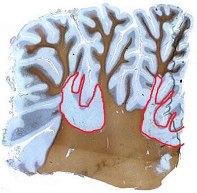 Cerebellar Dysfunction in Multiple Sclerosis